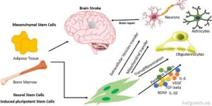 Avances en biotecnología ofrecen esperanza para recuperar funciones tras un ictus mediante células madre
